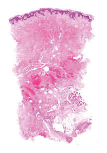 Histologia BTM: 18 meses