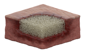 Aplicação do NovoSorb MTX — MTX